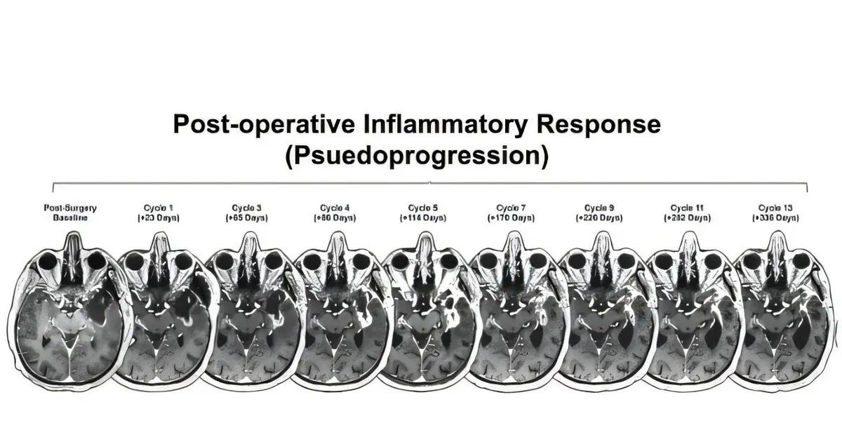 Scientists identify clues to making immunotherapy more effective against glioblastoma