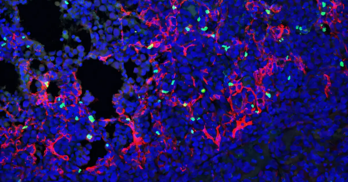 New cell type reveals how lung tumors may suppress immune defenses