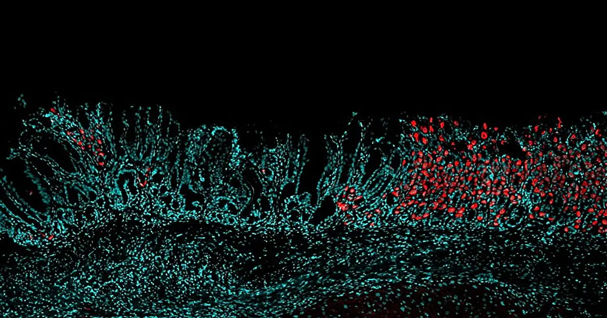 Uncovering gene-based clues to how disrupted healing in stomach cells increases cancer risk