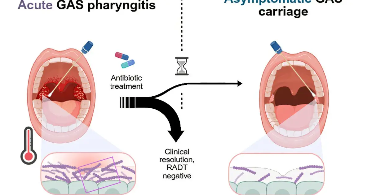 Exploring why strep throat can linger, even after treatment with antibiotics