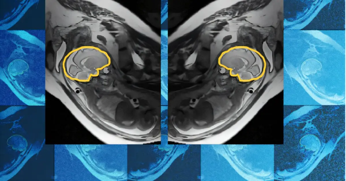 Why teaching AI about symmetry could make prenatal diagnosis more reliable