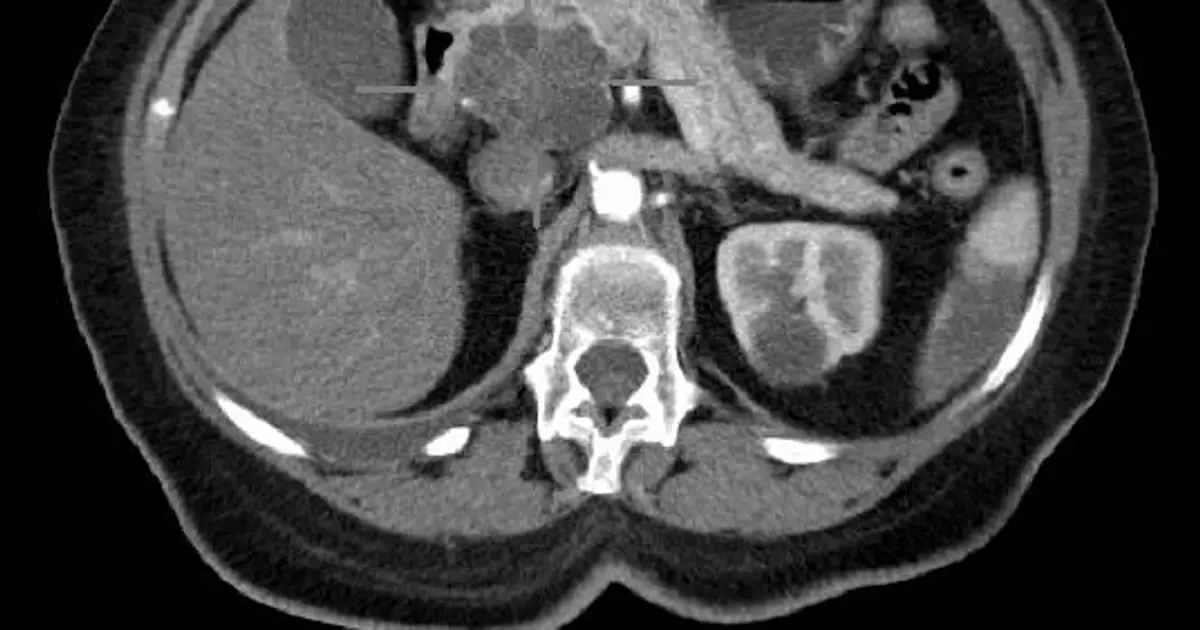 New targeted therapy shows promising early results in advanced pancreatic cancer