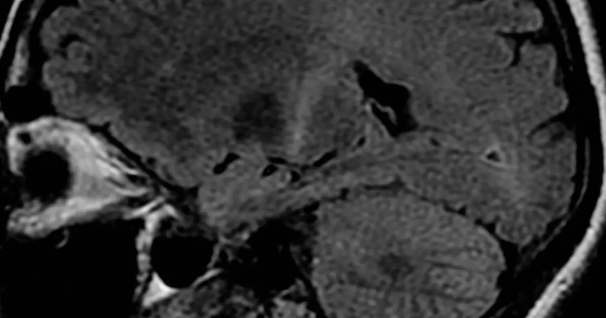 Promising experimental drug could shield nerve cells from amyotrophic lateral sclerosis damage