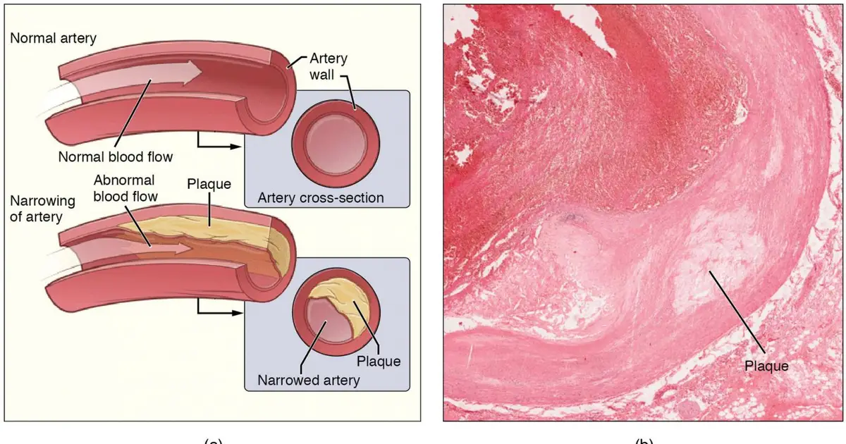 Study identifies potential new target for treating atherosclerosis