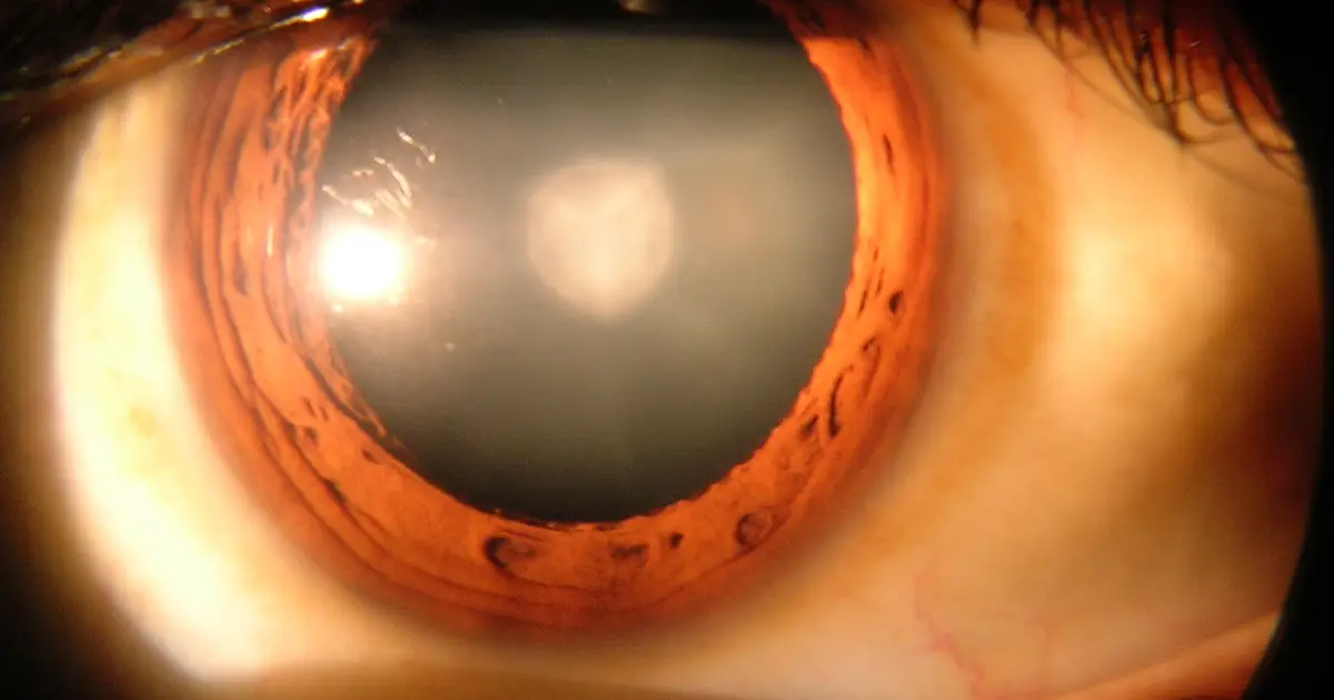 People exposed to more polluted air may face higher risk of glaucoma and cataracts