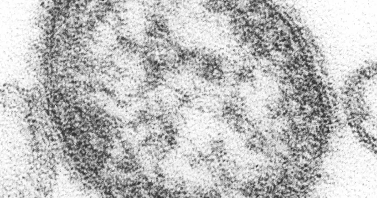 US measles epidemic grows with South Carolina outbreak