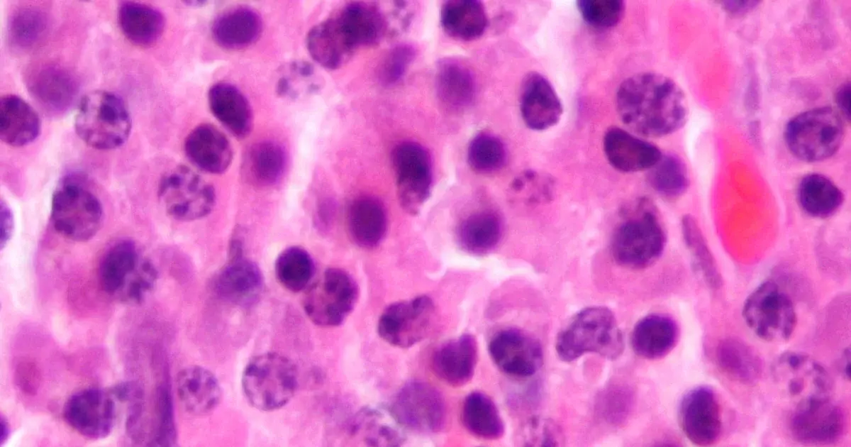 New therapeutic target expands options for multiple myeloma