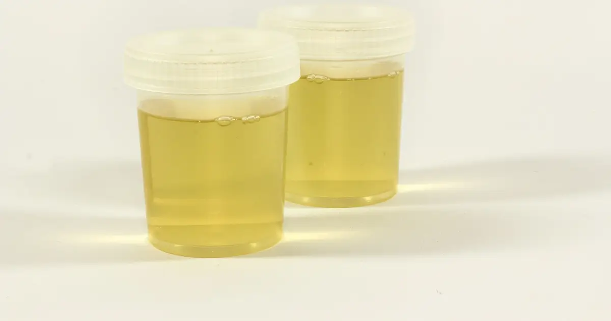 Urine test identifies more than nine in ten bladder cancers, clinical study finds