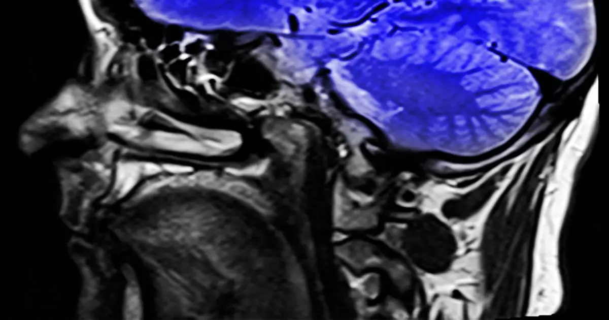 New study provides first evidence of dopamine system injury in the brain of long COVID patients
