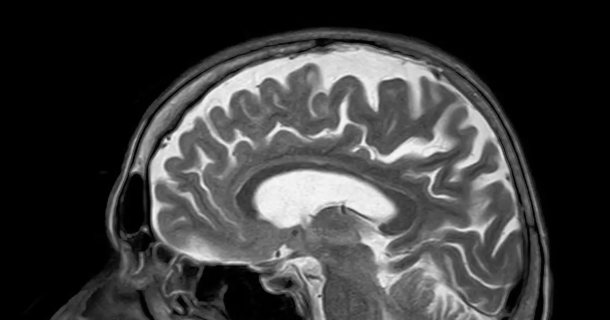Brain MRI surveillance without prophylactic cranial irradiation improves cognitive outcomes in small cell lung cancer