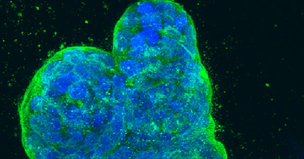 Scientists identify molecule driving one of the deadliest forms of breast cancer