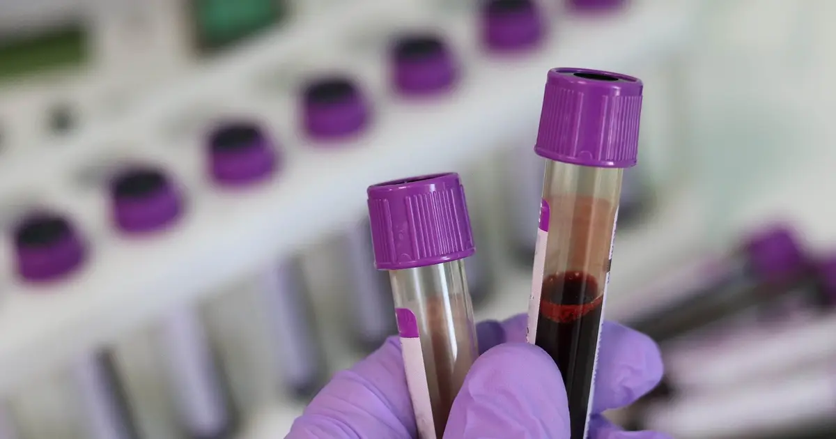 Blood RNA markers may flag lung cancer risk 10 years before diagnosis