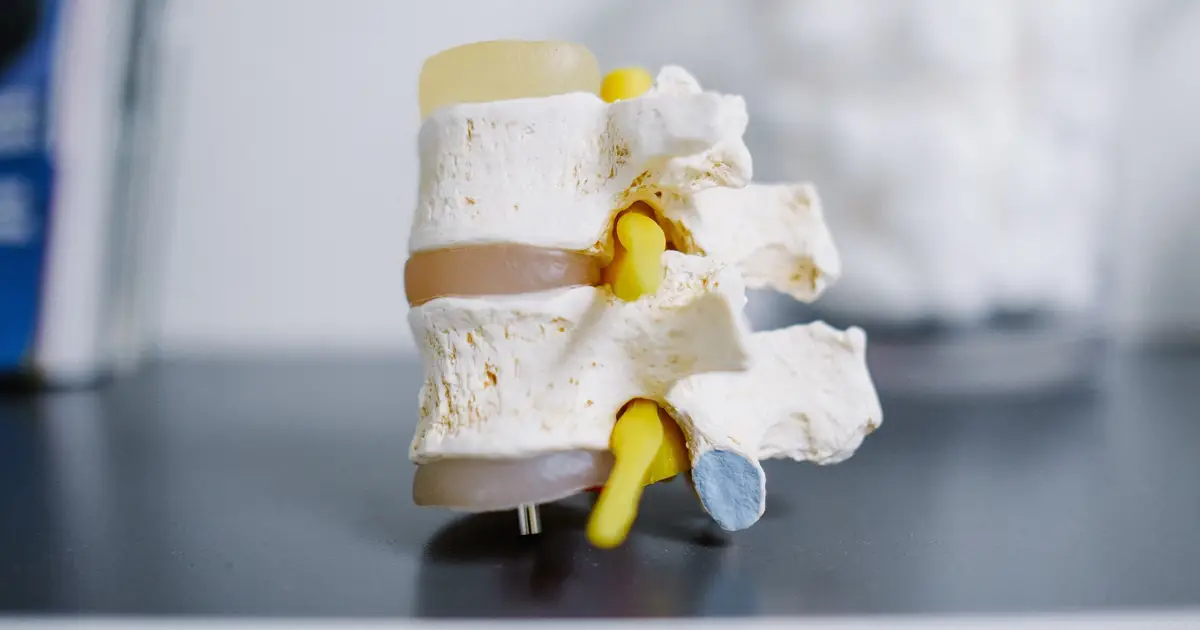 Early axial spondyloarthritis diagnosis linked to lower long-term spinal damage