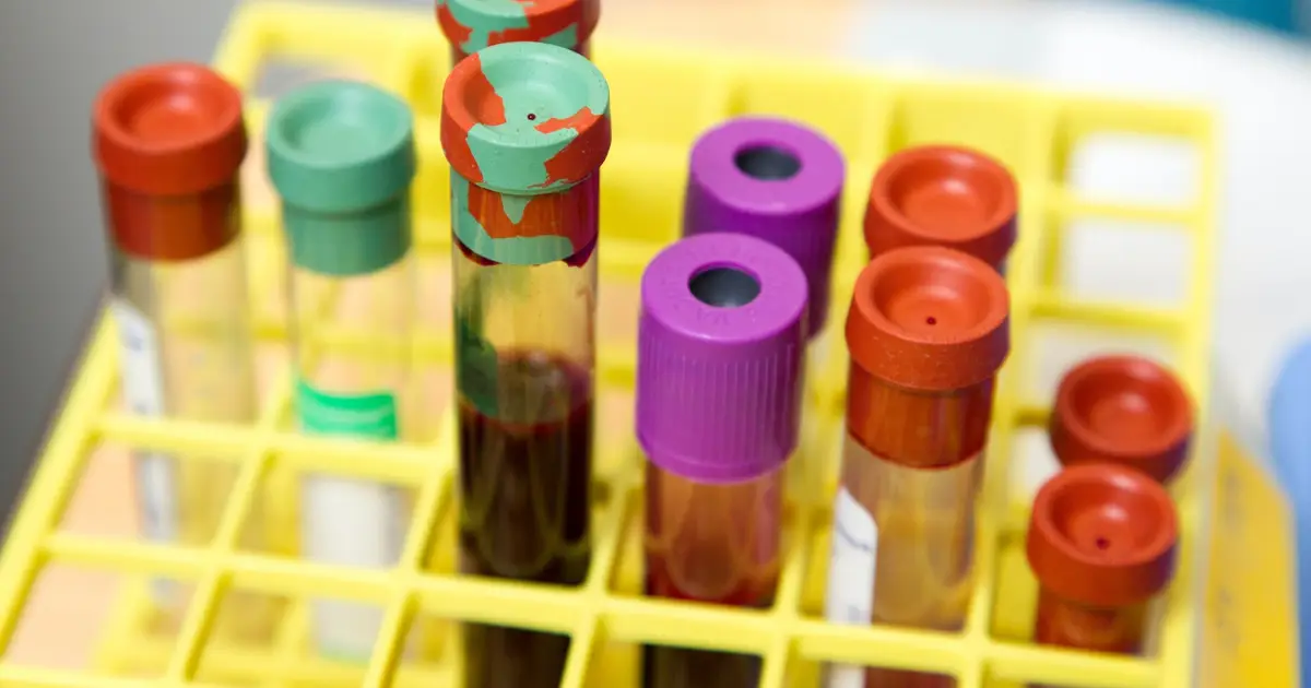 Blood test shows promise for detecting testicular cancer when standard markers miss
