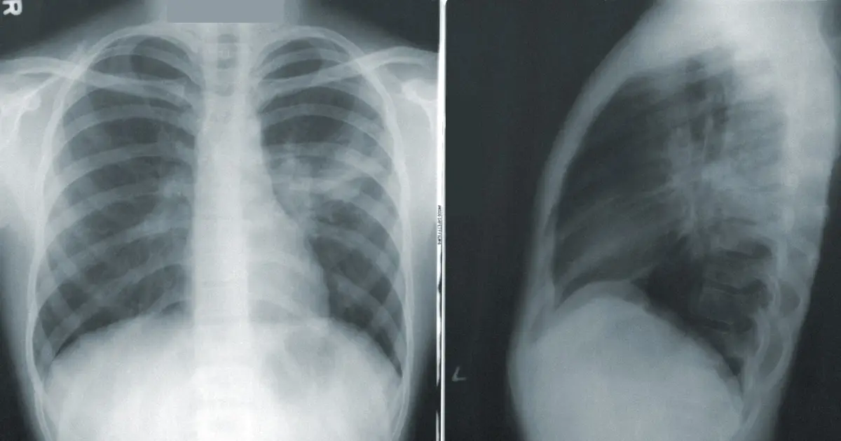 Twice-daily radiation linked to better quality of life in lung cancer trial