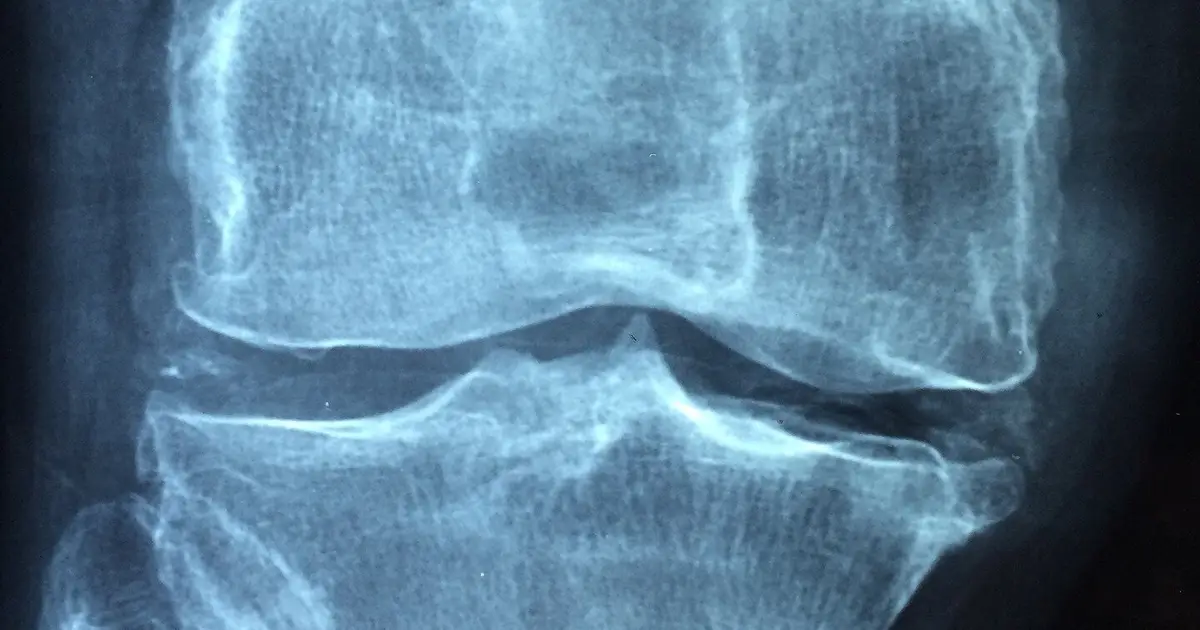 Call for systematic bone health optimization before joint replacement and spinal fusion surgery