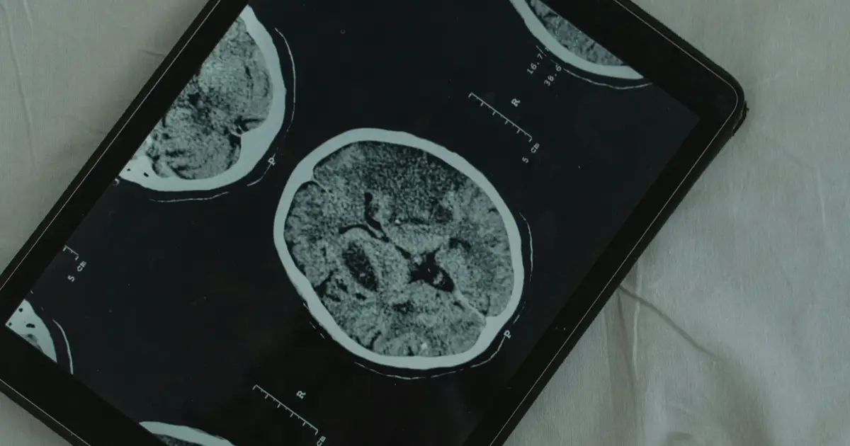 Brain scans reveal tau buildup in late-onset psychosis