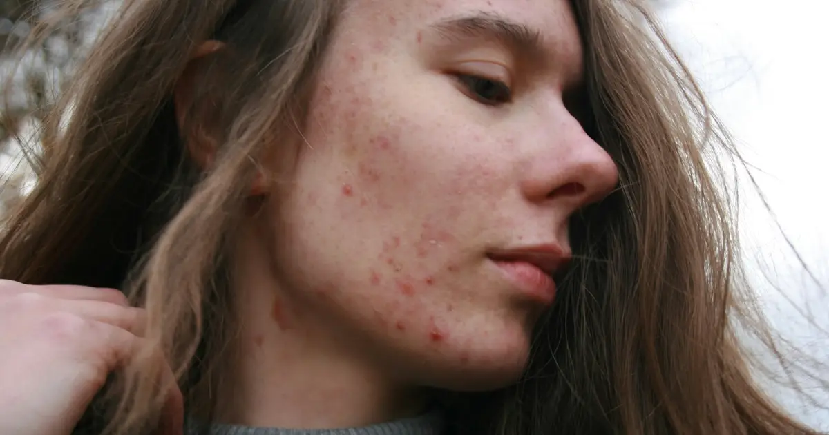 1990 to 2023 saw increase in global burden of acne