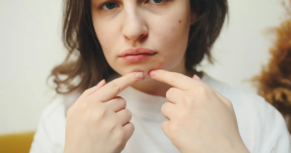 Do pimple patches actually work? Here's what the science says