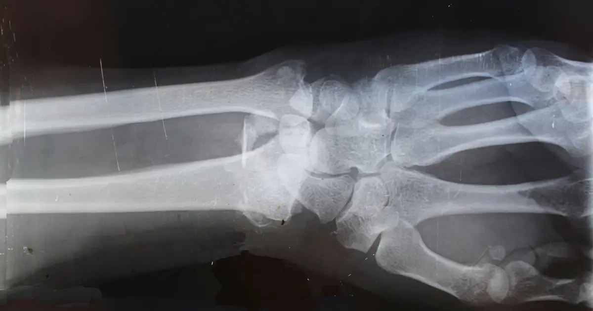 The bone fractures that often go unlinked to osteoporosis