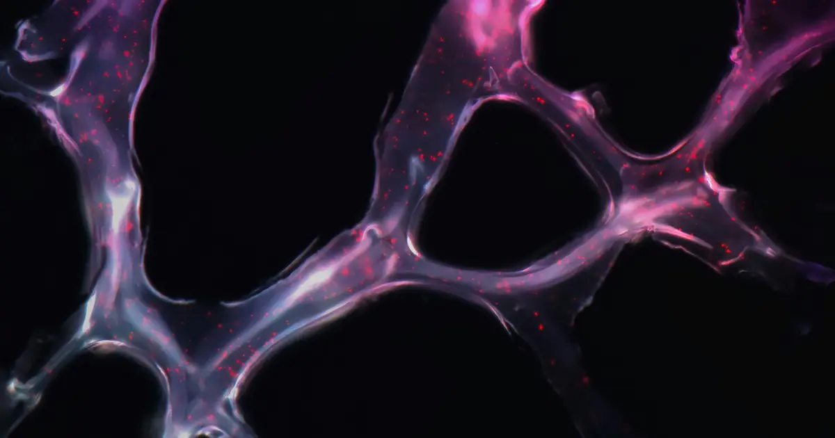 Immune ecotypes may explain multiple myeloma outcomes missed by disease staging