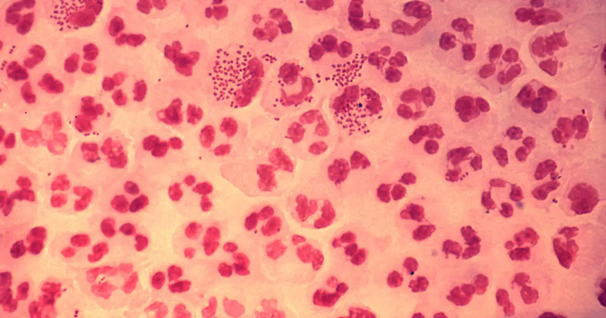 Two new therapies and rapid tests could reshape drug-resistant gonorrhea care