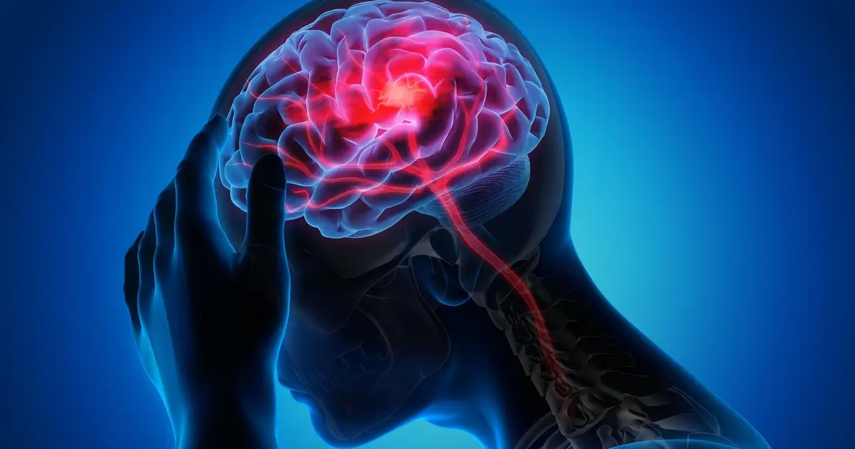 Anti-epileptic drug may reduce migraine aura