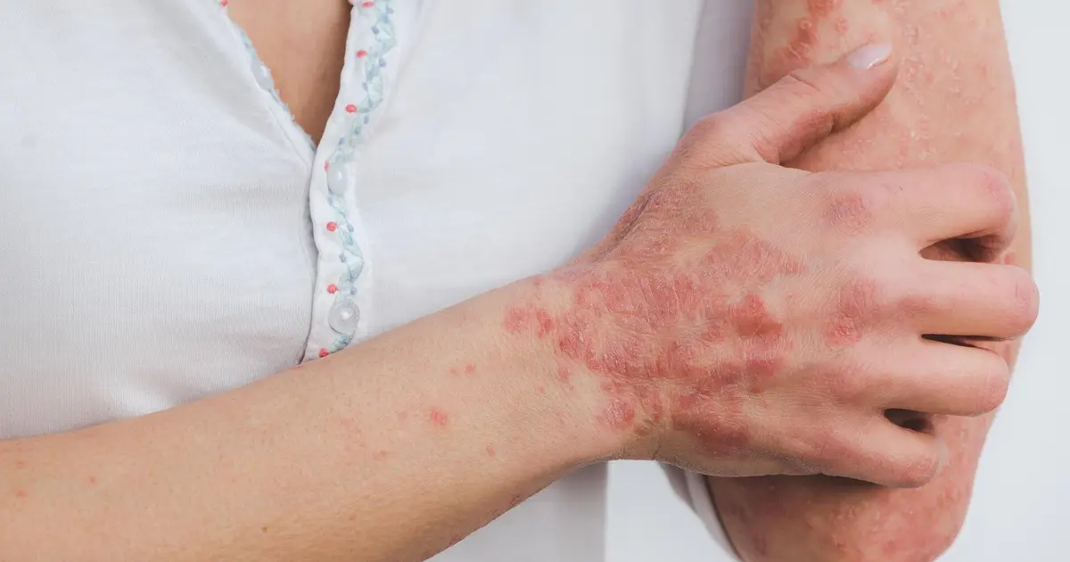 Big data analysis sheds light on psoriasis's genetic code