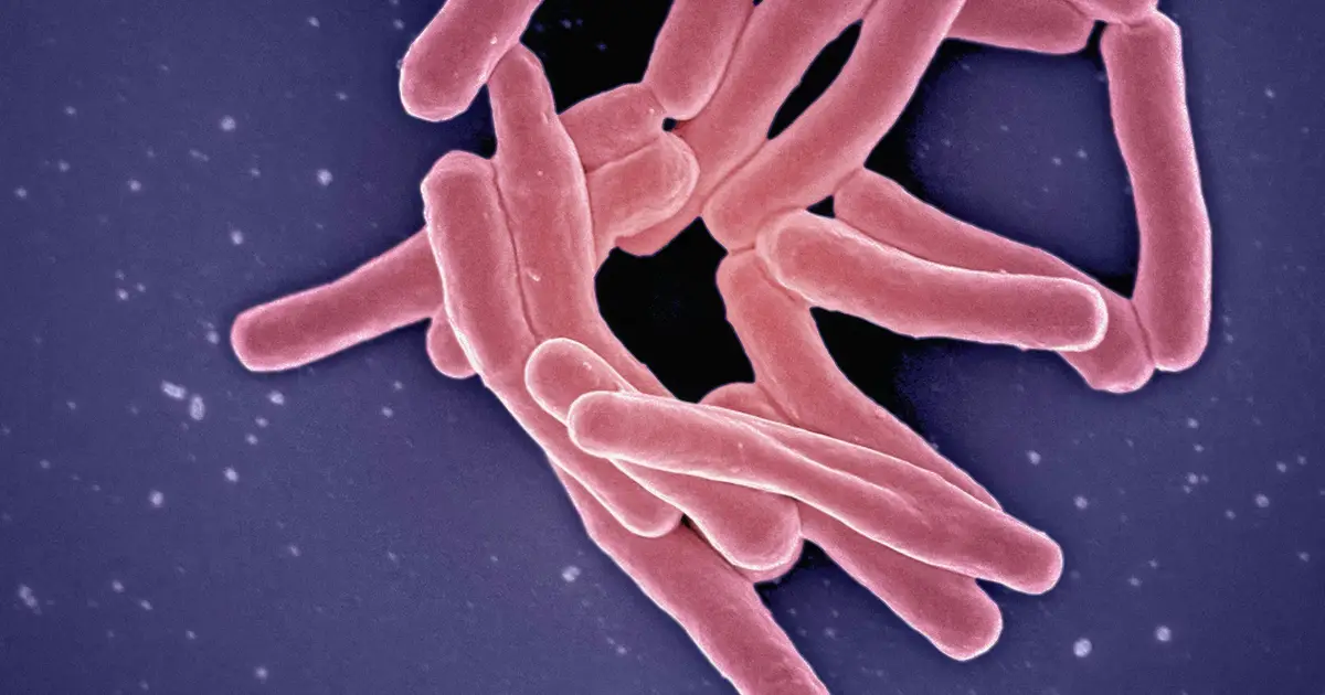 Hundreds of people in England have died before doctors diagnosed their tuberculosis
