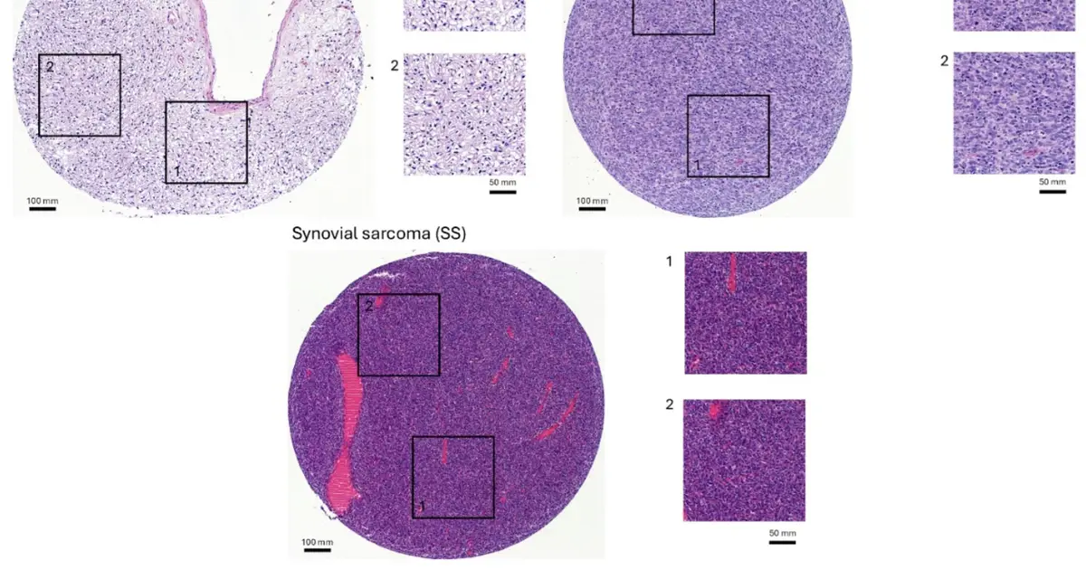A new AI tool distinguishes Ewing sarcoma from similar tumors