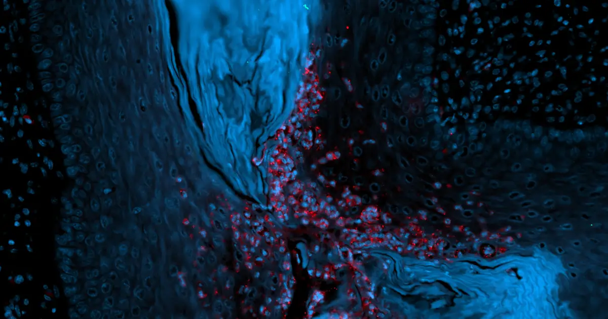 How one of the body's own proteins drives the vicious cycle of inflammation in vaginal yeast infections
