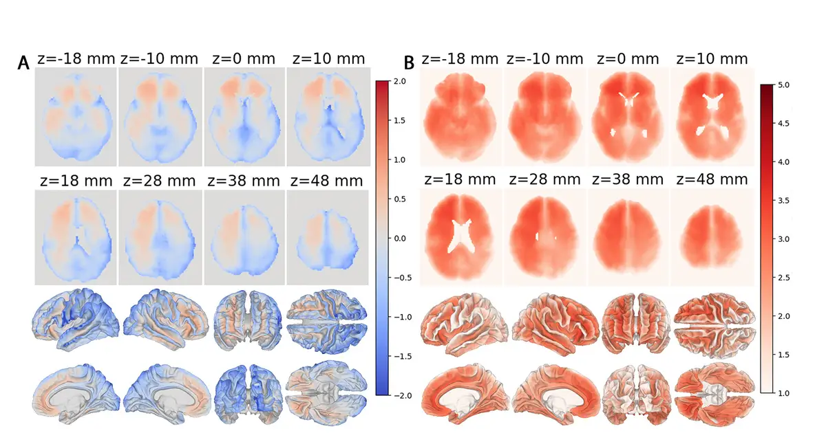 AI-enabled measurements of 'local brain aging' offer detailed insights on dementia and more