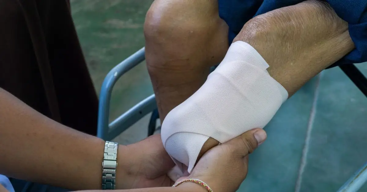 Amputation rates on the rise for opioid-, non-opioid-related hospitalizations