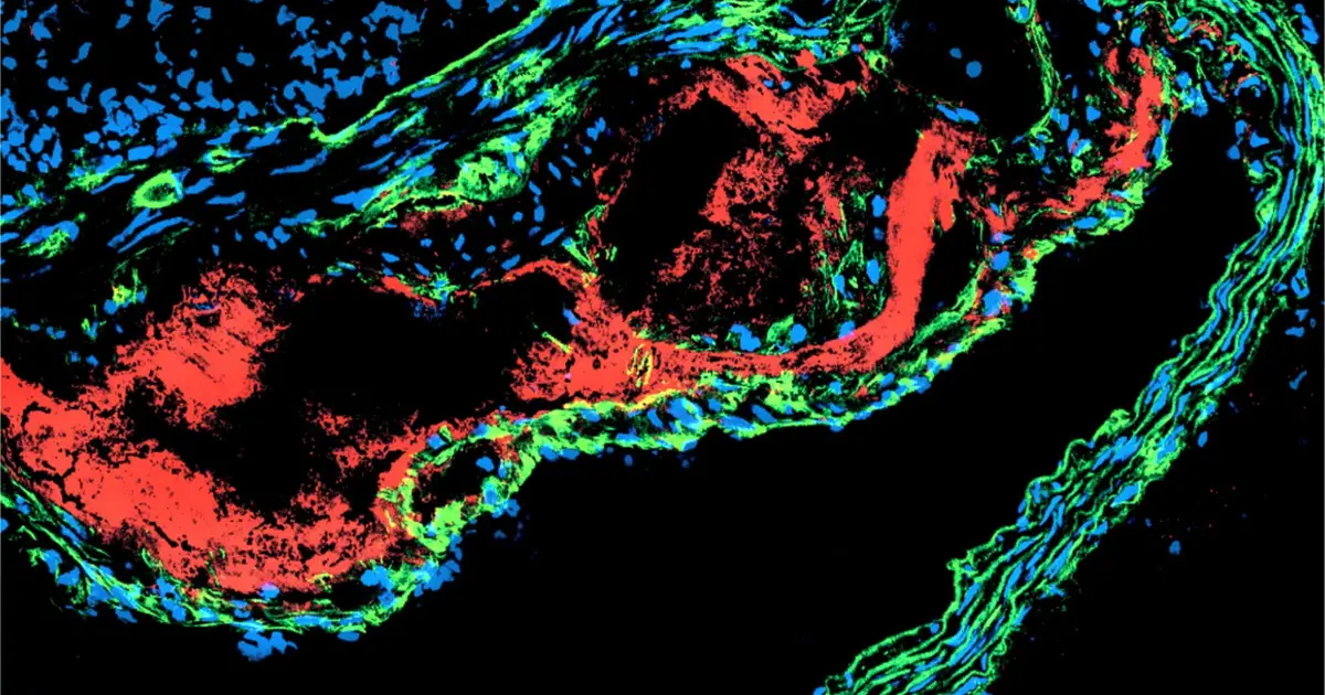 Atherosclerosis may meet key criteria for autoimmune disease, evidence suggests