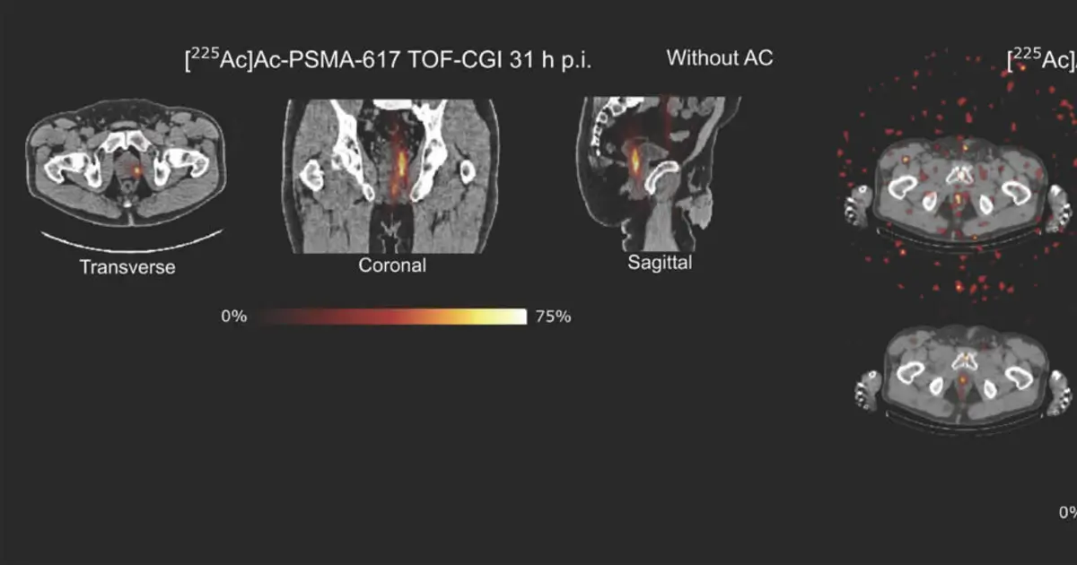 PET scans reveal alpha cancer therapy isotope with new algorithm in first human test