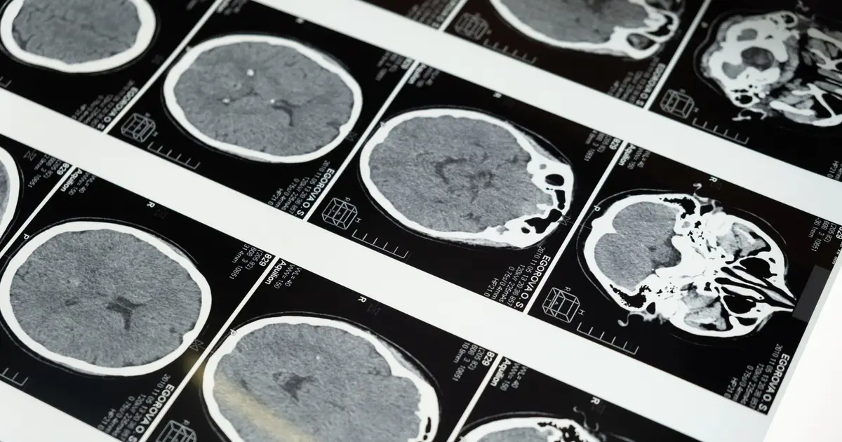Fractionated radiosurgery reduces recurrence after surgery for brain metastases, may improve survival