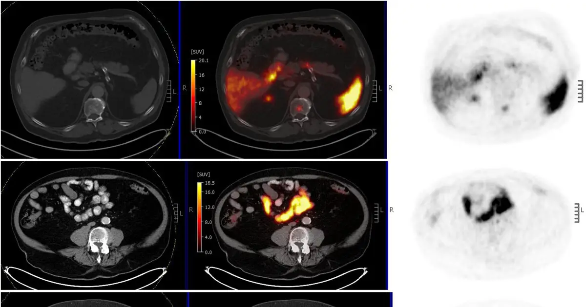 Case report highlights multidisciplinary approach to recurrent prostate cancer