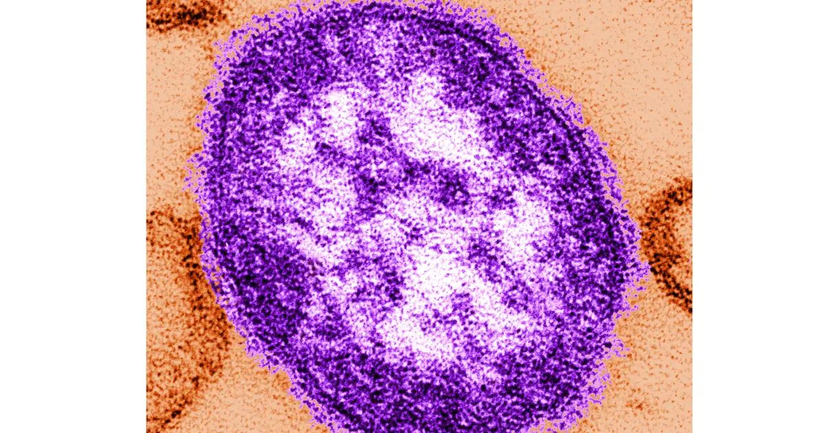 Coroner releases details of infants who died amid growing Pennsylvania measles outbreak