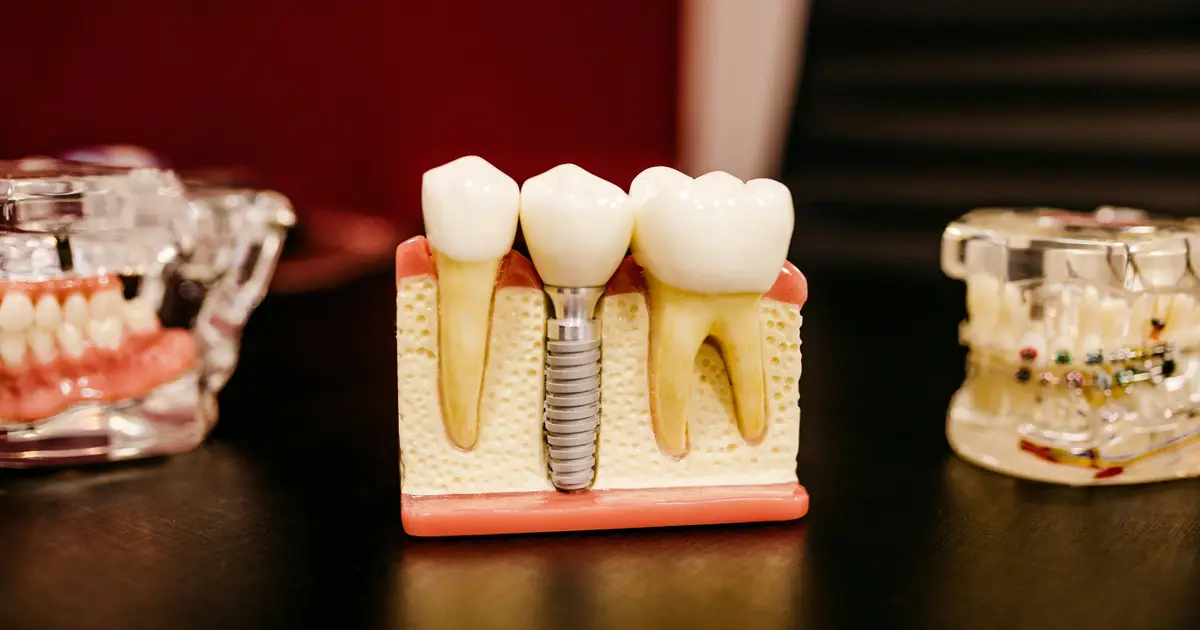 Diabetes tied to higher tooth and implant loss over 10 years