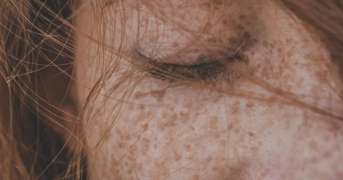 Detecting skin cancer even before it becomes visible with AI-assisted image recognition