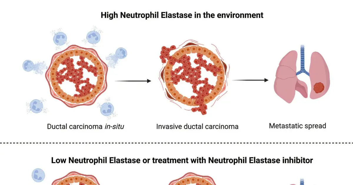 Immune mechanism discovery could help predict which early breast cancers will spread