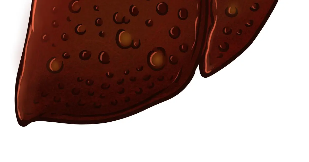 Why some adults under 50 may develop early-onset cirrhosis from fatty liver disease