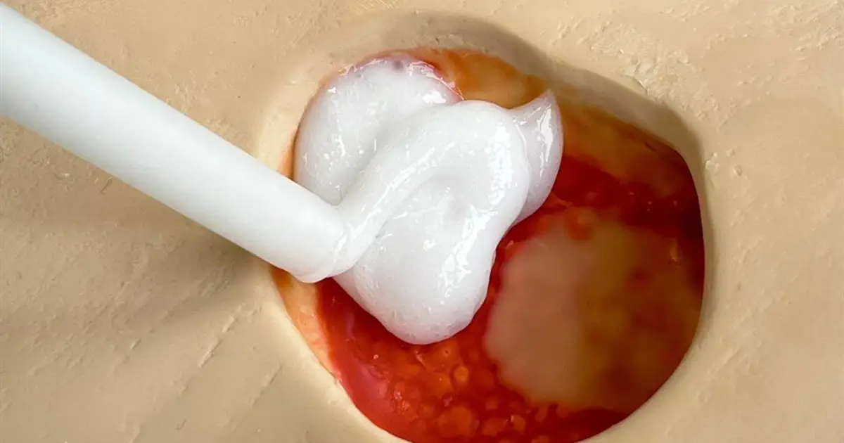 Injectable foam prototype could seal deep wounds and help prevent amputations