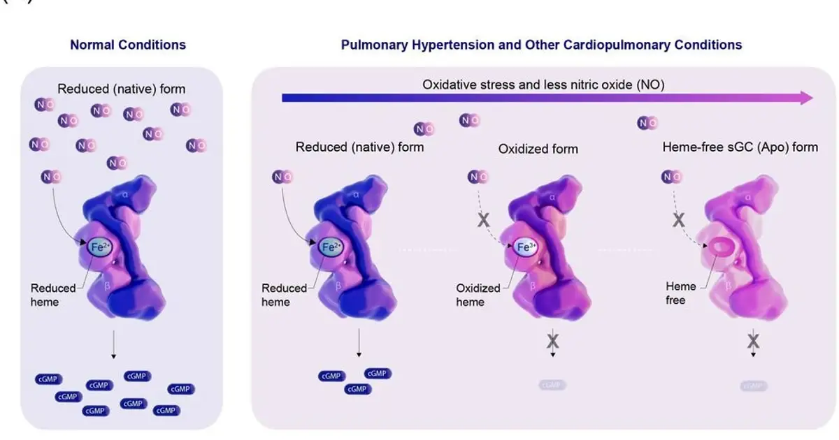 Inhaled drug shows promise for rare lung disease combination