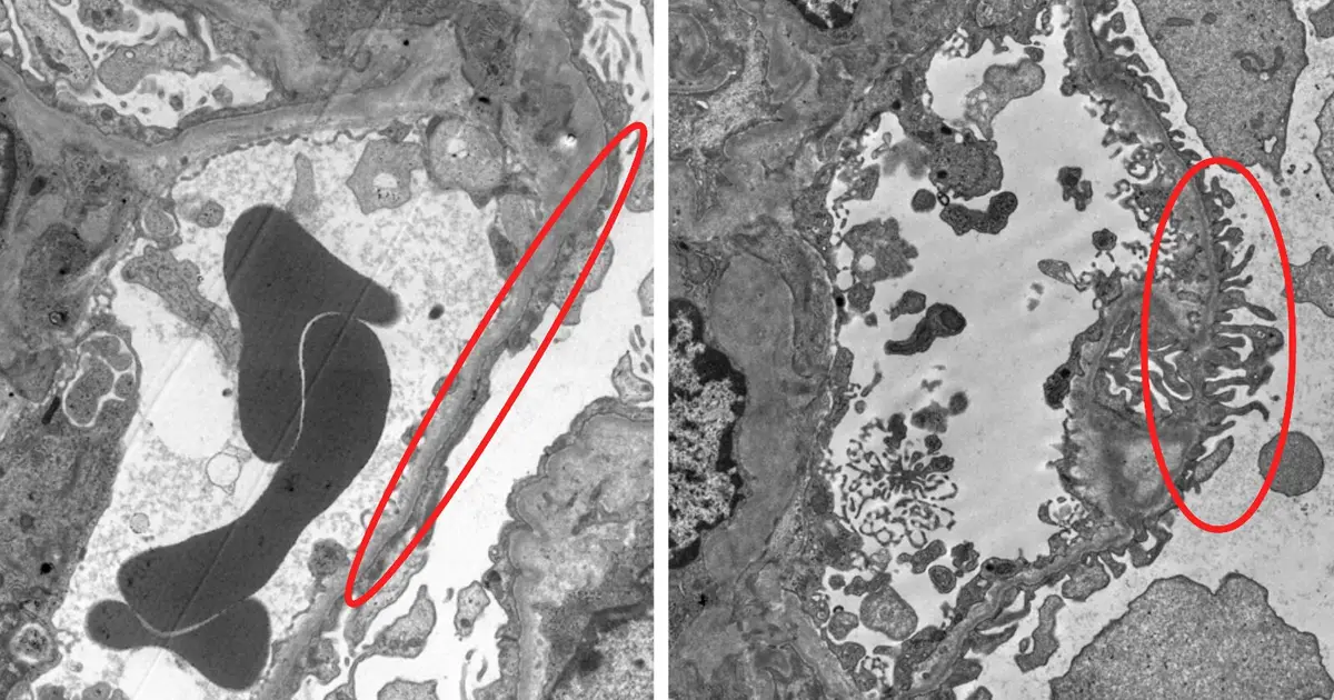 Beyond B cells: Rituximab response may reveal which kidney disease patients can stop steroids