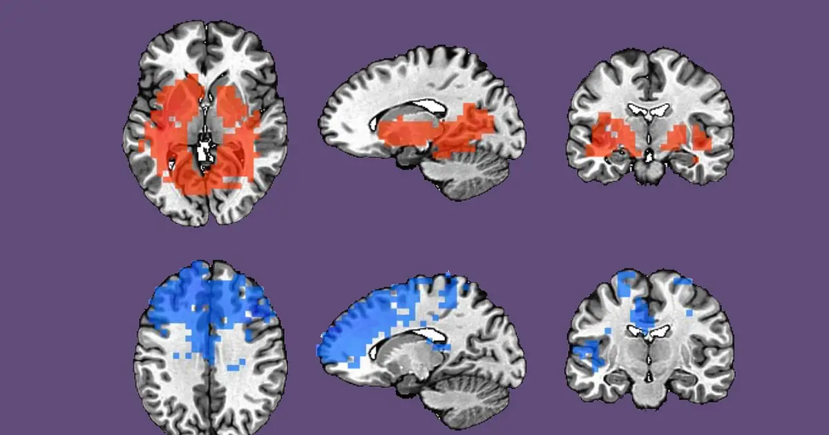 Immune signals may help predict responses to therapies for difficult-to-treat depression
