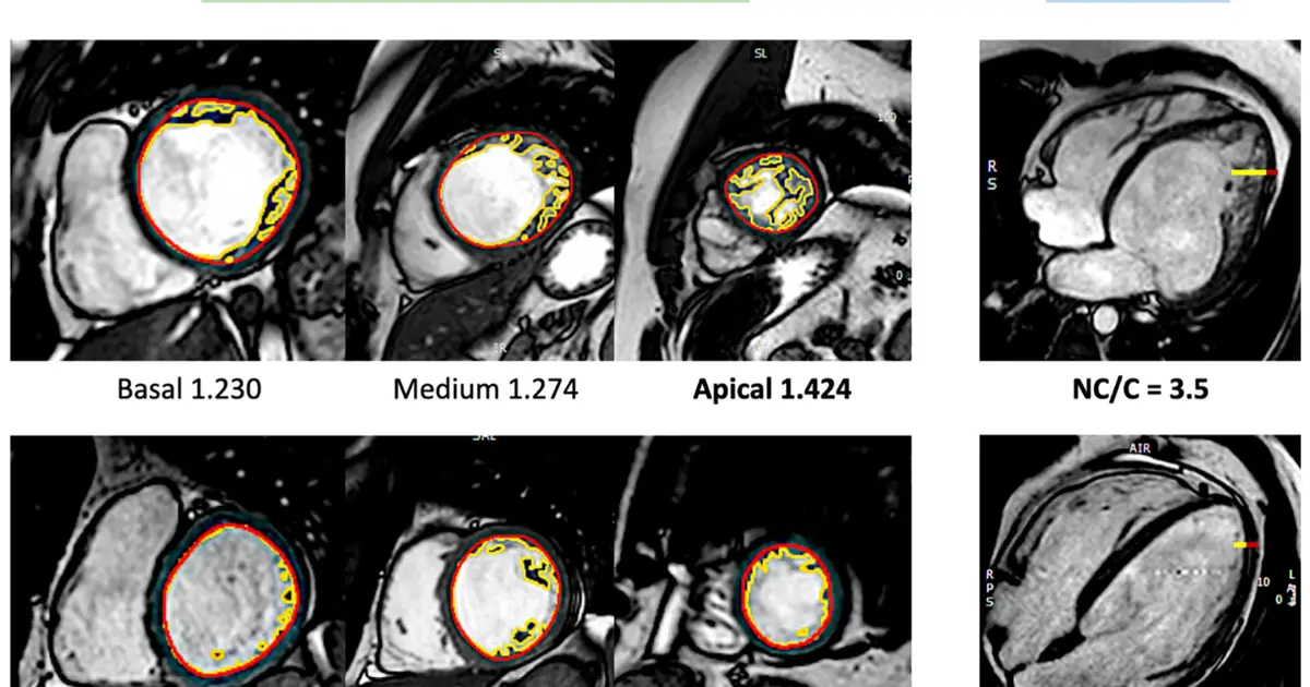 MRI and genetic data find no independent risk from hypertrabeculation