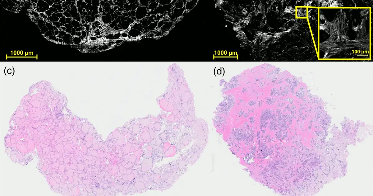 Light-based imaging offers hope in improving thyroid cancer diagnosis while reducing surgeries