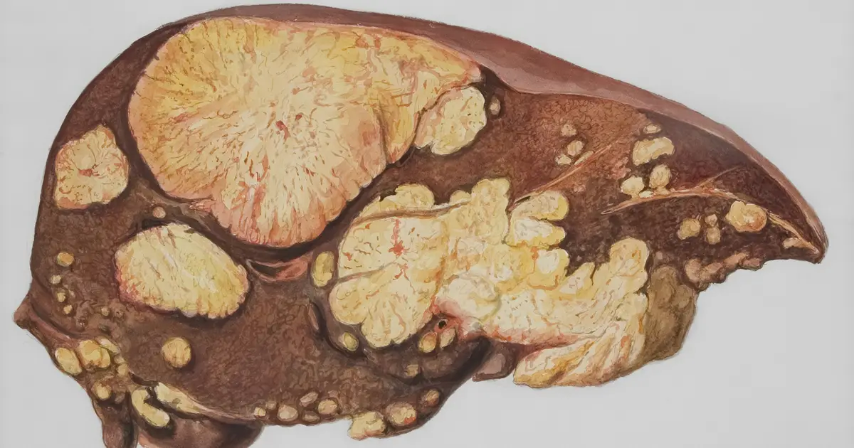 Protein discovery reveals potential treatment target for common fatty liver disease