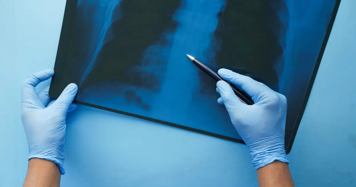 IASLC tumor budding grade identifies high-risk patients with resected lung squamous cell carcinoma